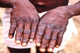 Centre Urges States to Enhance Mpox Surveillance and Isolation Facilities